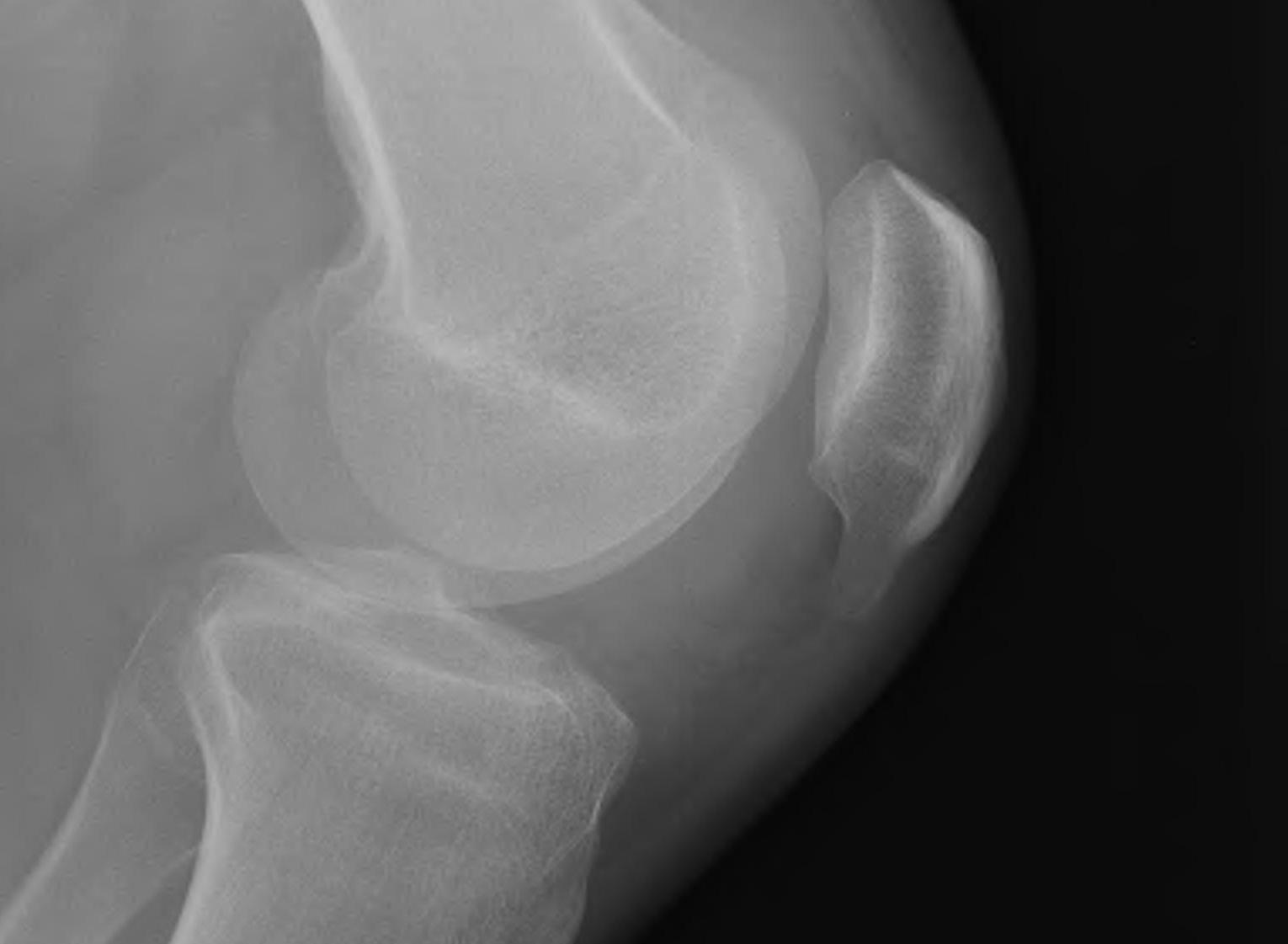 Patella Spur